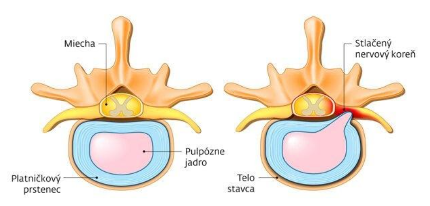 Bolesť kolena z chrbtice - Zdravá a poškodená platnička