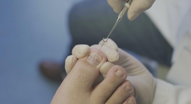 Barefoot a zarastajúce nechty
